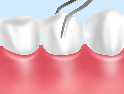 歯の揺れ度の検査